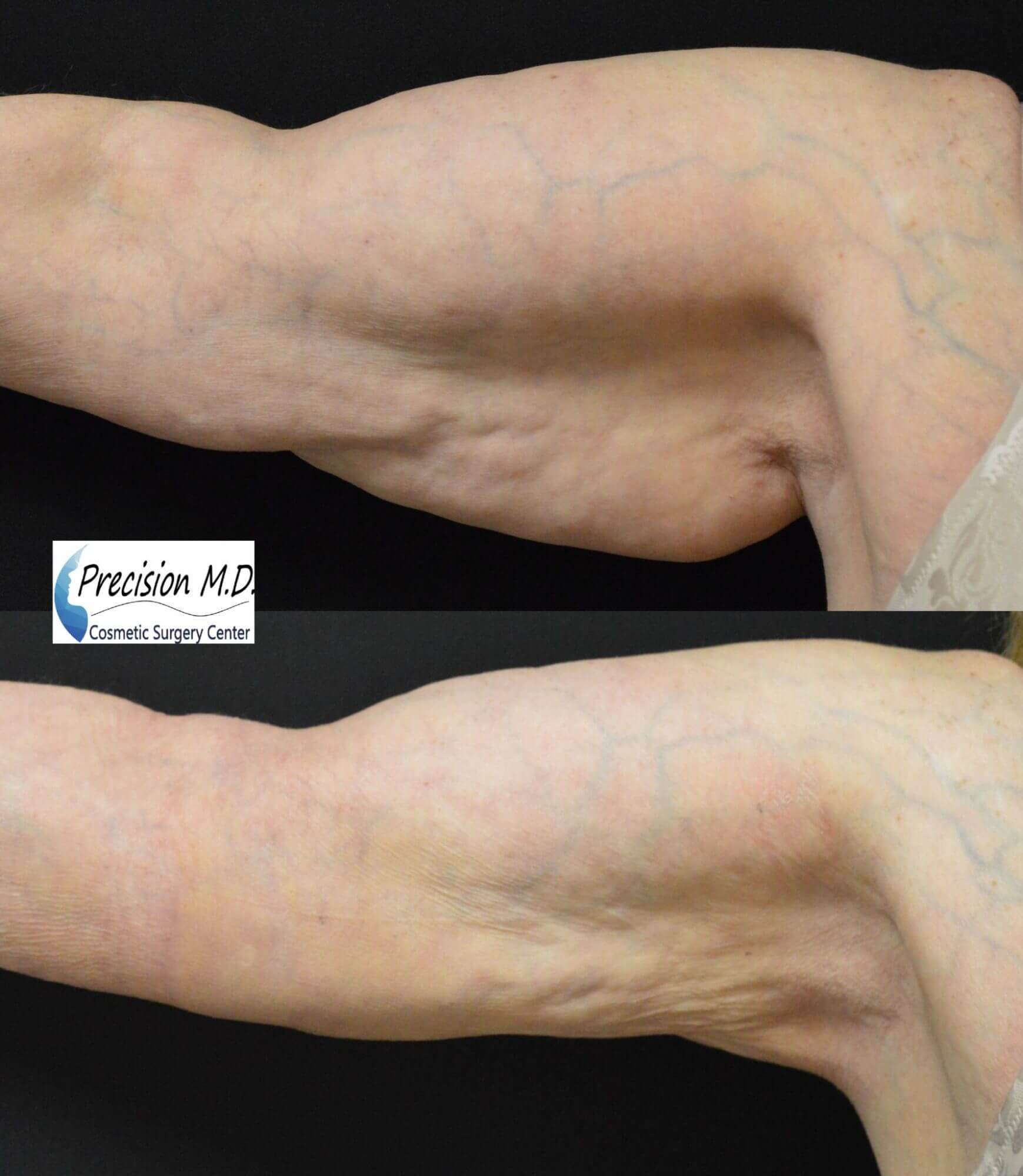 VASERlipo Sacramento Precision MD