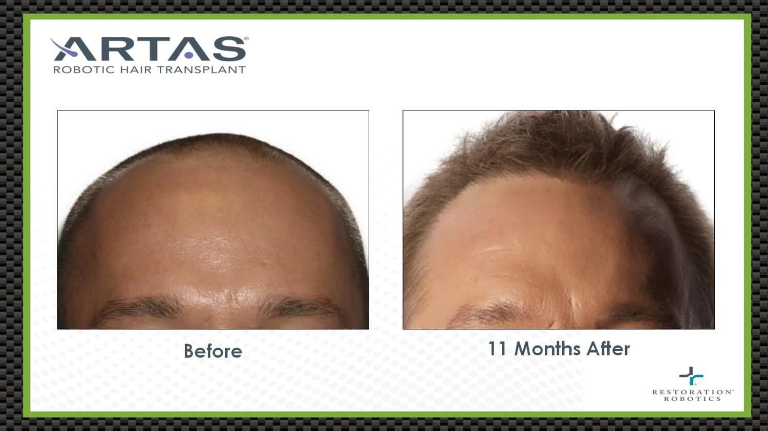 Hair Transplant Sacramento | Hair Loss Treatment Sacramento