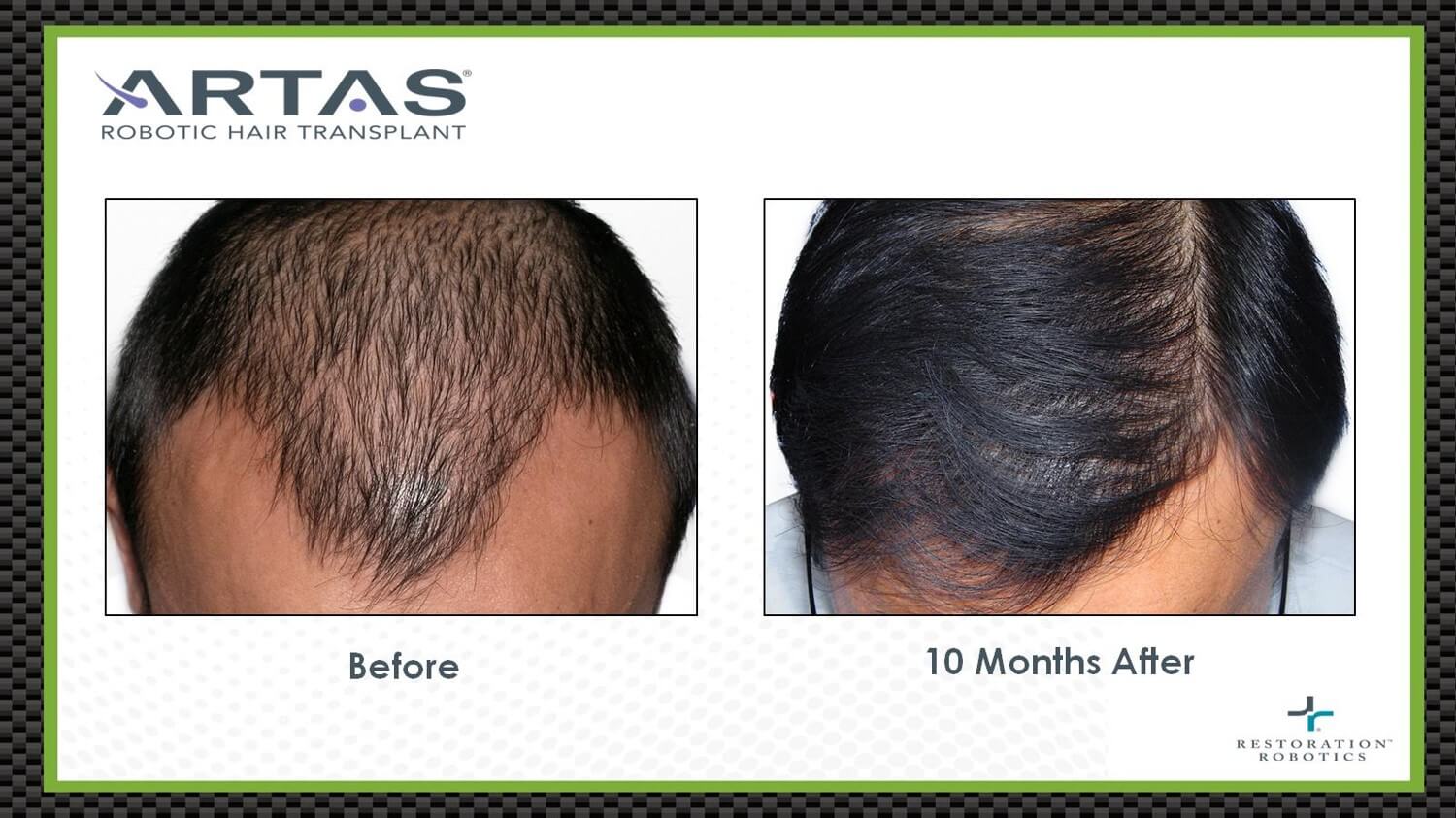 ARTAS Hair Transplants In Sacramento Precision MD