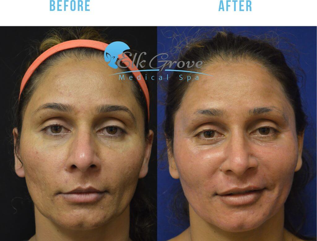 HALO Laser Skin Resurfacing in Sacramento - Precision MD