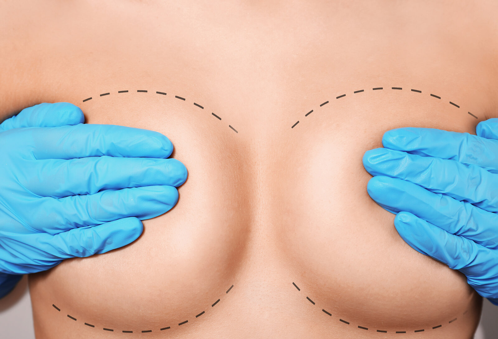 Non Surgical Breast Lift - Medical Injectables