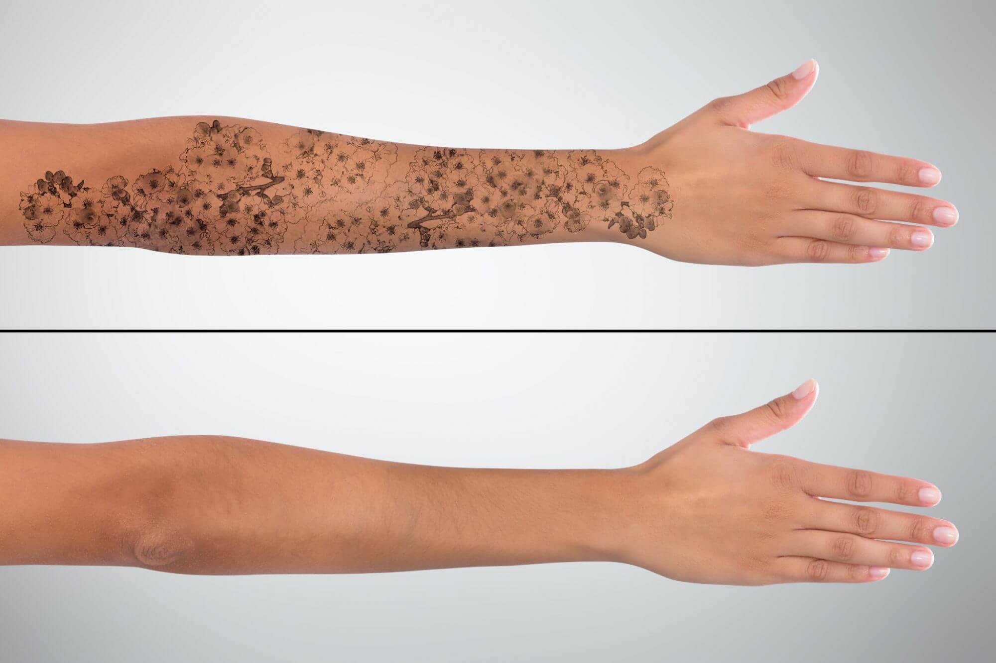 Laser Tattoo Removal – Healthy Dermis