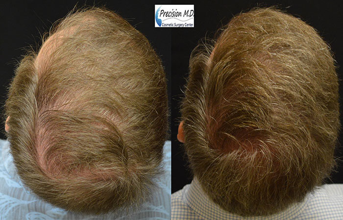 Hair transplant results 2