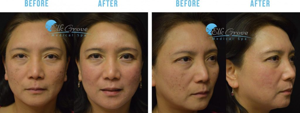 Before and After Acne Scar Treatment Sacramento CA