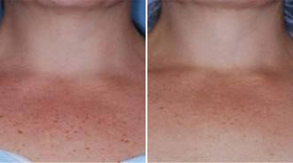 Before and after BBL chest Treatment - Precision MD