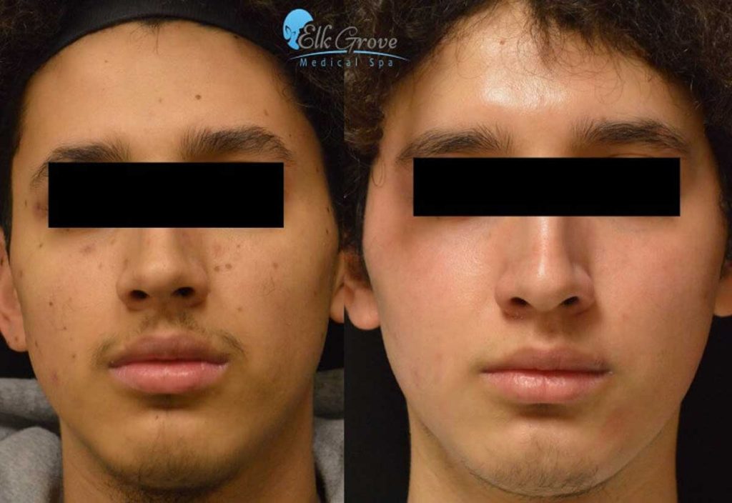 Before and After Laser Spot Removal Treatment