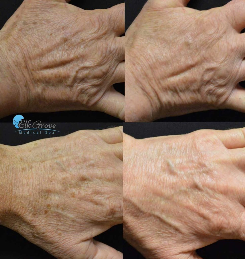 Before and After Age Spot Laser Treatment on the hand