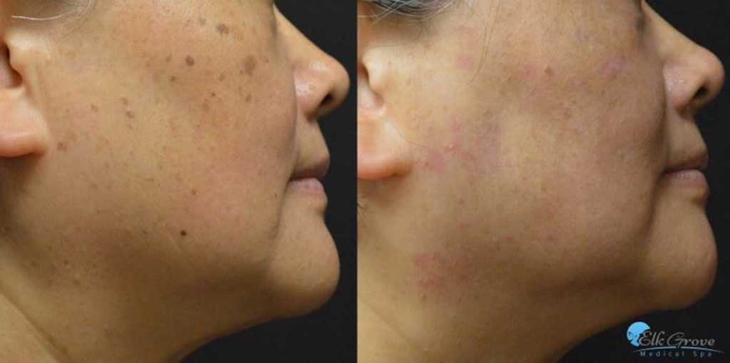 Before and After Age Spot Laser Treatment