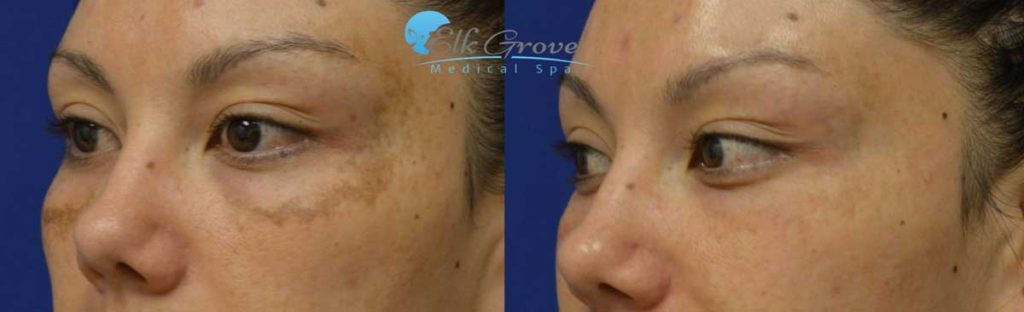 Brown & Age Spot Removal in Scottsdale & Paradise Valley