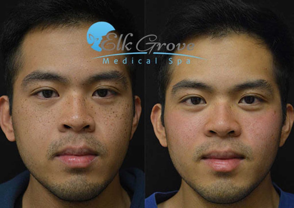 Before and After Laser Spot Removal Treatment