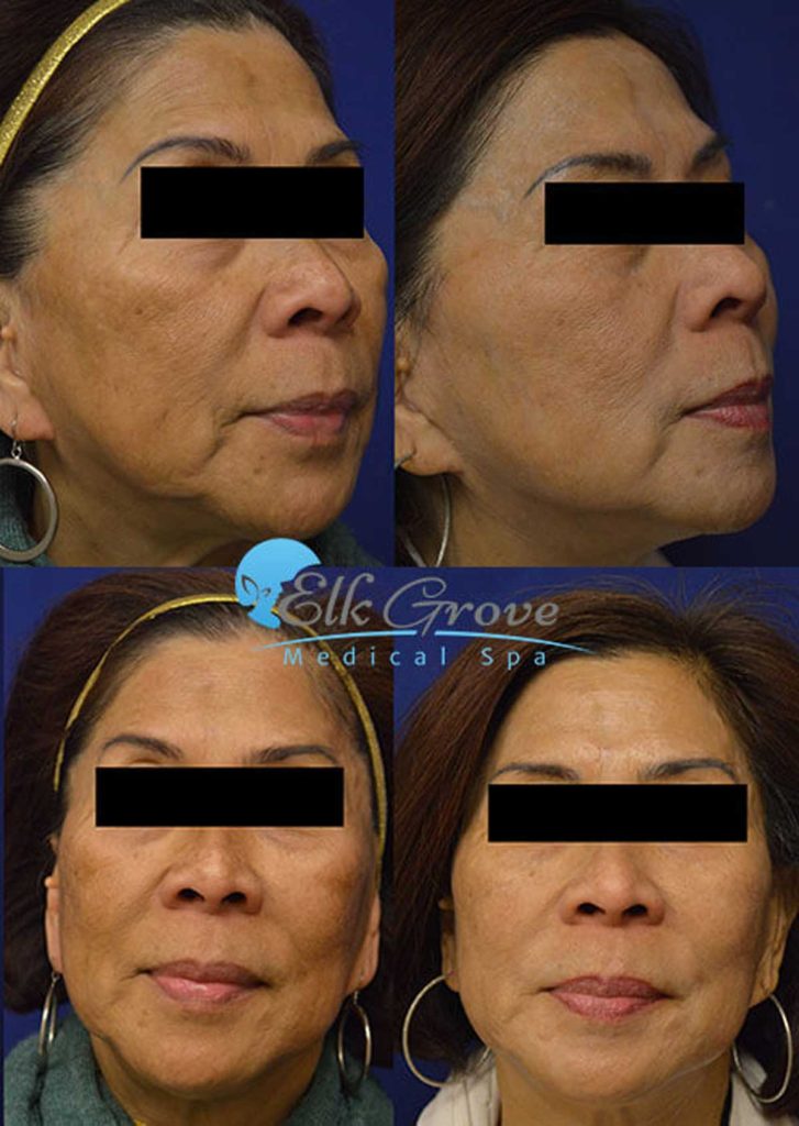 Before and After Age Spot Removal Treatment