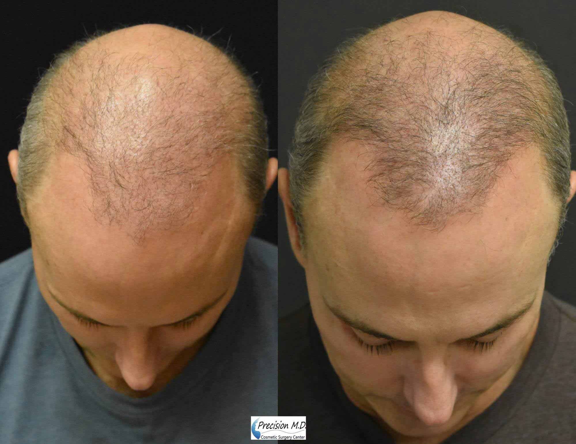 Before After Hair Restoration 01 