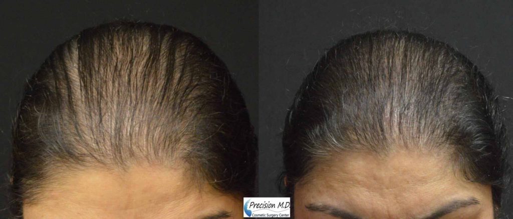 Before and After Hair Restoration showing the top of a woman's head