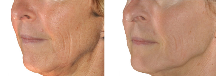 Before and after results - INFINI Wrinkle Treatment