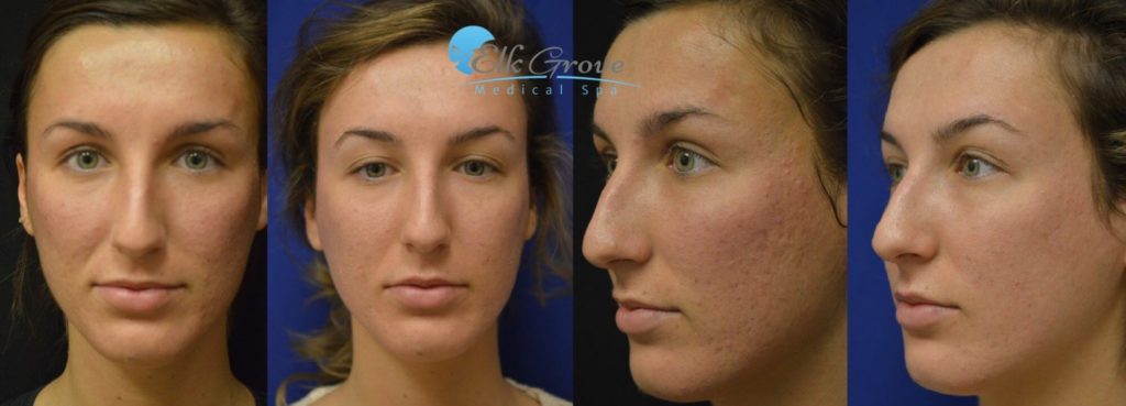 Acne Scar Removal Before and After, Halo Hybrid