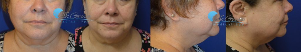 Kybella Before and After | Precision MD