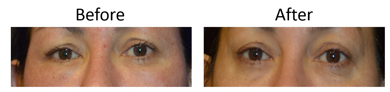 Before and After Laser Eyelid Lift Sacramento