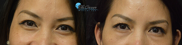 PRP Eye Bag Treatments Before and After