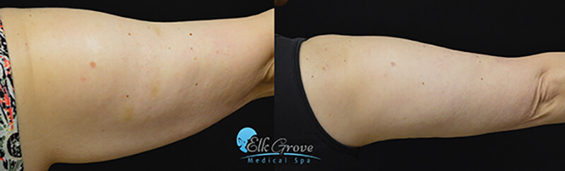 Before and after Coolsculpting treatment on the arms