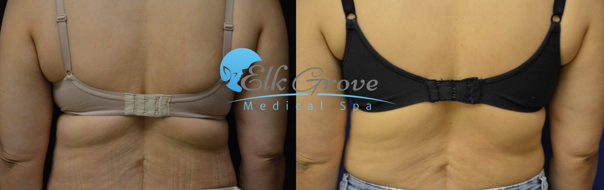 Before and after Coolsculpting treatment