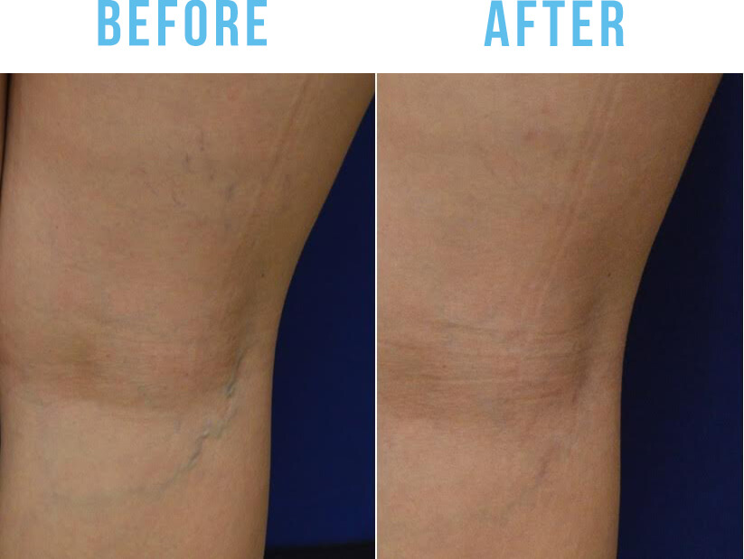 Spider Vein Treatment Before and after Sacramento, CA